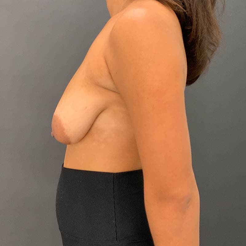 Breast Augmentation Before & After Image