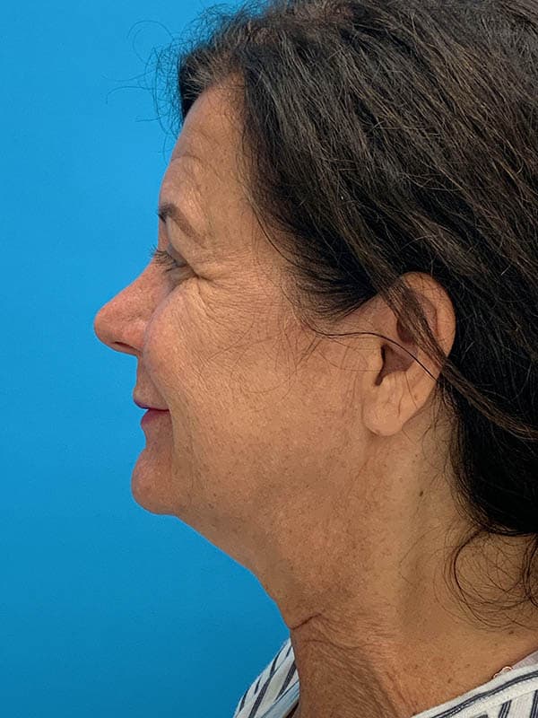 Neck Lift Before & After Image