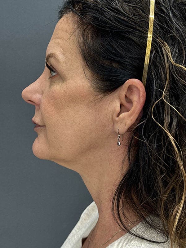 Neck Lift Before & After Image