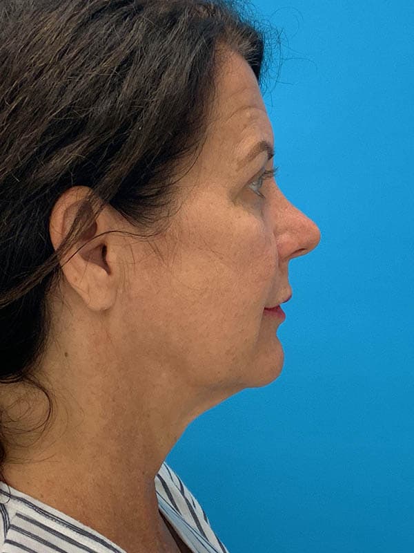 Neck Lift Before & After Image