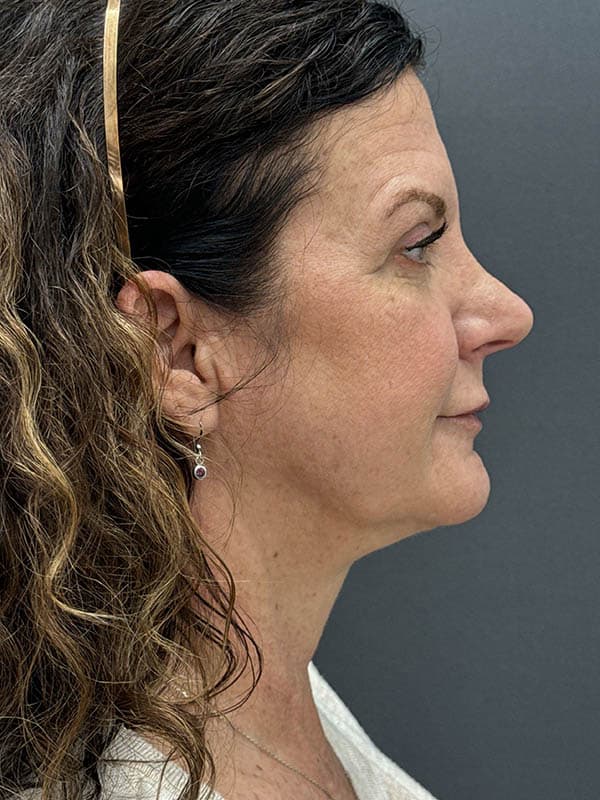 Neck Lift Before & After Image